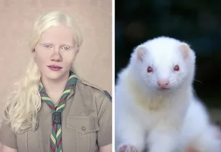 Albino Hastalığı: Tanım, Türleri, Sebepleri ve Tedavi Yöntemleri